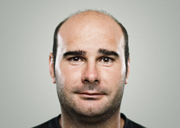 El revolucionario tratamiento contra la calvicie que probablemente nunca vea la luz