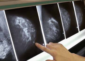 Un autotrasplante elimina el cáncer en una paciente con metástasis