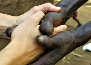 Combatimos al peor enemigo de la lepra: el hombre