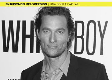 La cabeza se llena de costras tras un implante capilar, ¿cómo hacen los famosos para disimularlo?