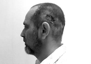implante pelo