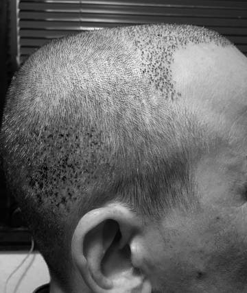 implante pelo