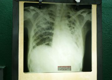 Una bacteria fácil de tratar convertida en un enemigo casi invencible