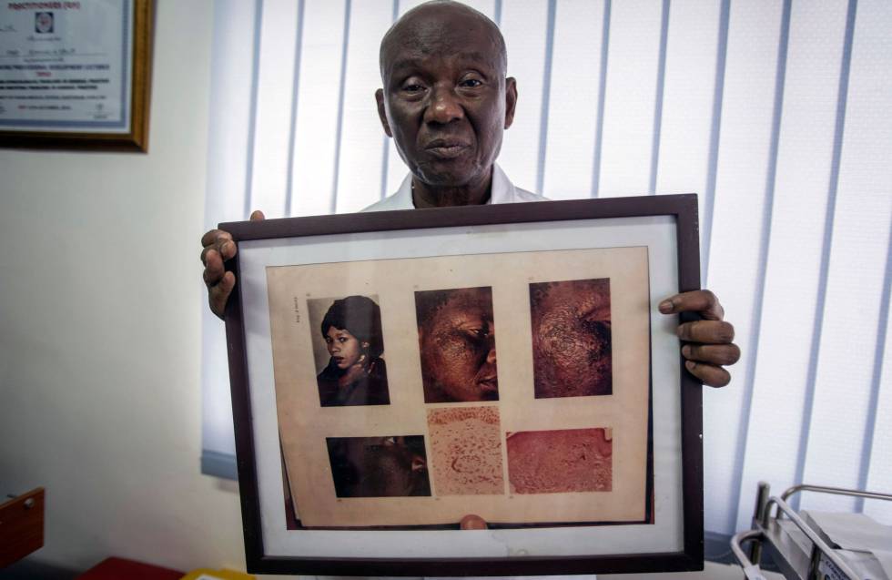 Edmund Delle, dermatólogo y dueño de una clínica en Accra (Ghana) muestra las fotos de una de sus pacientes con problemas cutáneos tras haber utilizado durante mucho tiempo productos blanqueantes con elementos tóxicos.