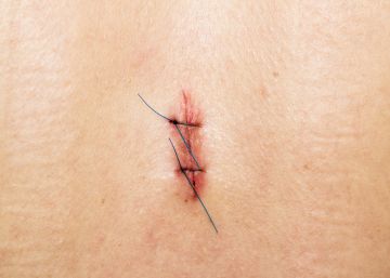 Una 'tirita' que podría sustituir los puntos de sutura de las heridas