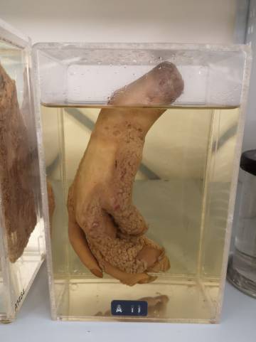 Una mano con lupus.