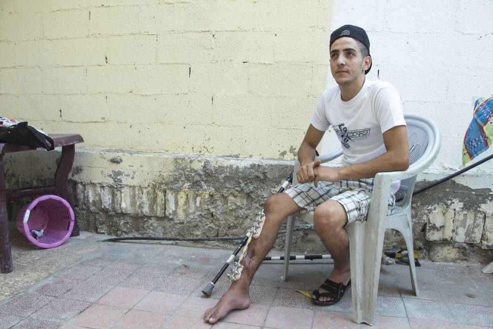 Eyad, de 22 años, necesita un injerto de hueso y una cirugía reconstructiva.