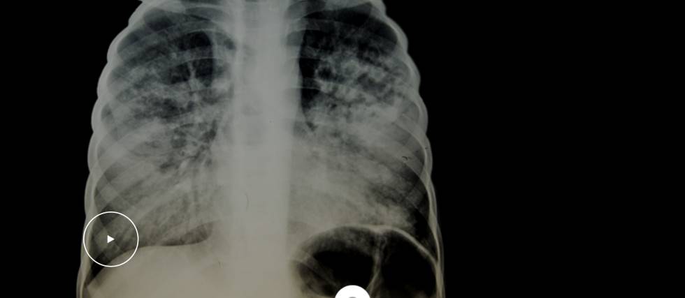 El día de la tuberculosis es todos los días