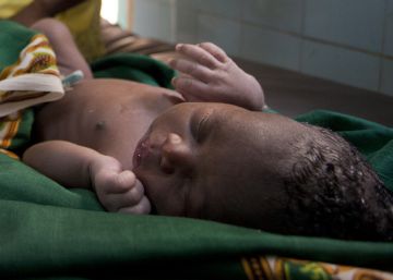 La muerte por cesárea es 100 veces más frecuente en países en desarrollo