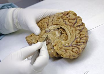 Identificado un nuevo tipo de demencia confundido hasta ahora con el alzhéimer