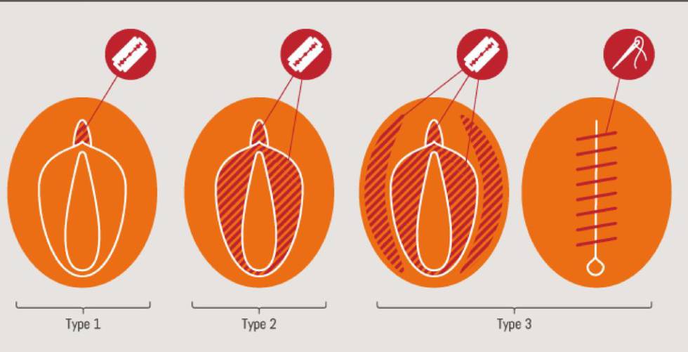 Tipos de Mutilación Genital Femenina.