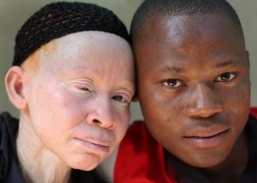 Ser una persona con albinismo no es igual en Europa que en África