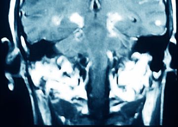 ¿Son reversibles los daños cerebrales del párkinson?