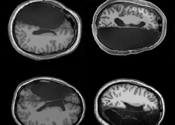 Lo que hemos aprendido gracias a seis personas que solo tienen medio cerebro