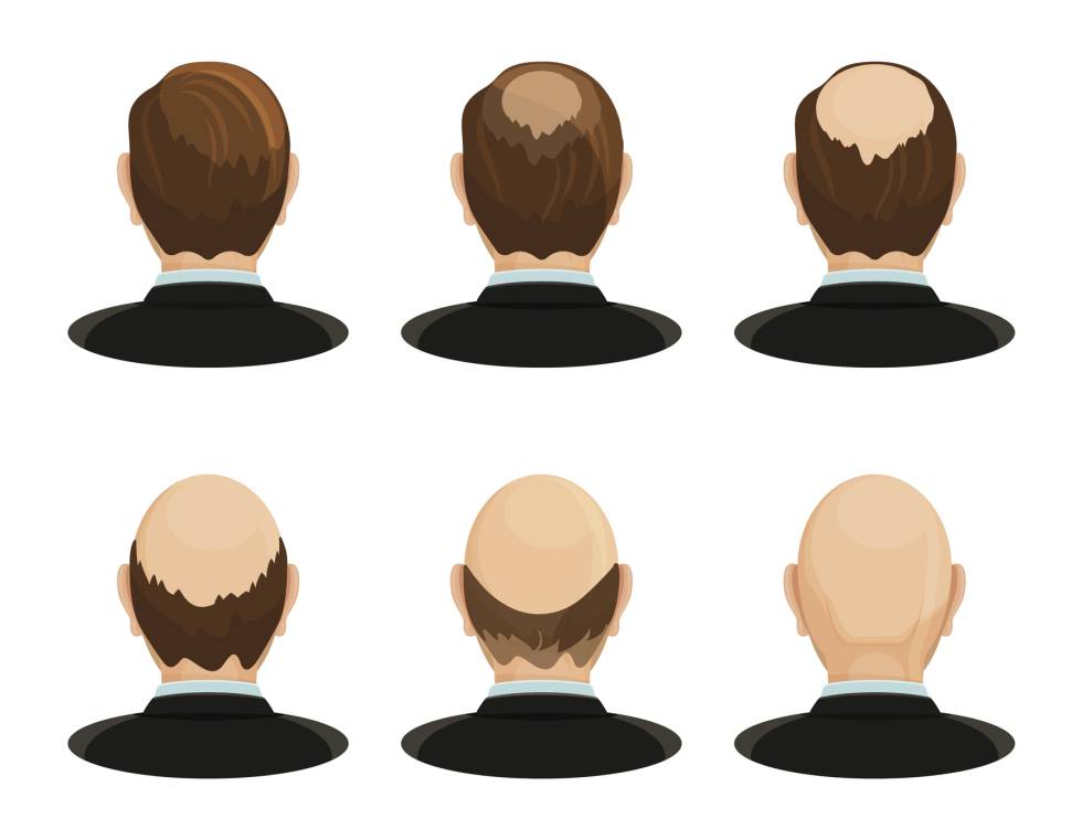 De nuevo, una dramatización de la pérdida de cabello.