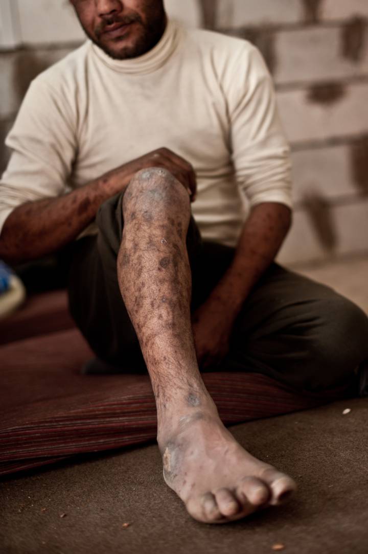 El sirio Mahmud Mohamed muestra las heridas sufridas tras ser torturado con descargas eléctricas en una cárcel del Gobierno sirio El sirio Mahmud Mohamed muestra las heridas sufridas tras ser torturado con descargas eléctricas en una cárcel del Gobierno sirio