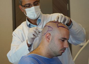 Istambul, a meca dos implantes capilares Istambul, a meca dos implantes capilares