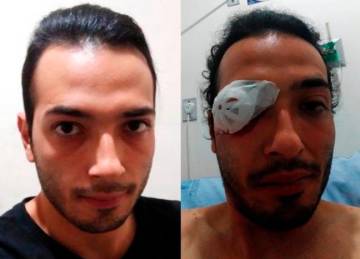 Wilmar Alexis Quiceno recibió el impacto de una granada aturdidora en Medellín el 21 de noviembre.