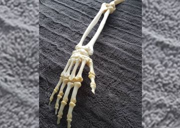 Un canadiense manda conservar el esqueleto de su brazo amputado Un canadiense manda conservar el esqueleto de su brazo amputado