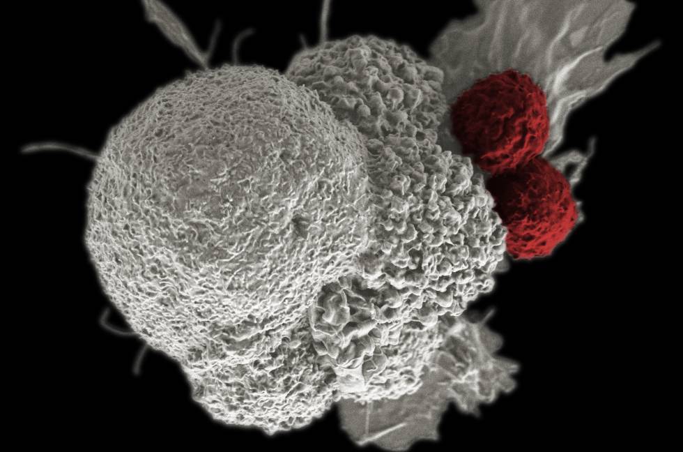 Célula de un cáncer de cabeza y cuello atacada por dos glóbulos blancos.