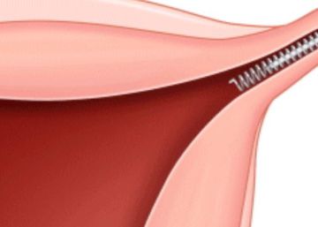Sanidad informa de la suspensión temporal de la comercialización del implante anticonceptivo Essure Sanidad informa de la suspensión temporal de la comercialización del implante anticonceptivo Essure