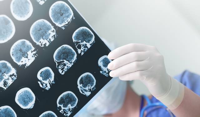 Un médico estudia el daño cerebral en un paciente.