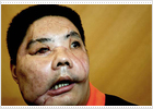 El primer hombre sometido a un trasplante de cara en China sale del hospital