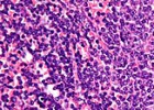 Unos anticuerpos atacan las células de la leucemia linfática crónica