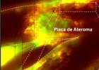 Grabada la obstrucción de la carótida que causa ictus e infarto