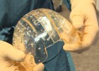 La tecnología 3D permite la implantación de un cráneo La tecnología 3D permite la implantación de un cráneo