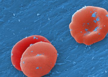 Una terapia génica intenta curar la hemofilia A