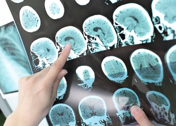 Pfizer ocultou indícios de que um de seus fármacos poderia prevenir Alzheimer