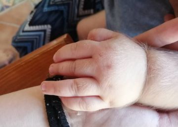 Una empresa farmacéutica de Málaga causa el síndrome del hombre lobo a 17 bebés