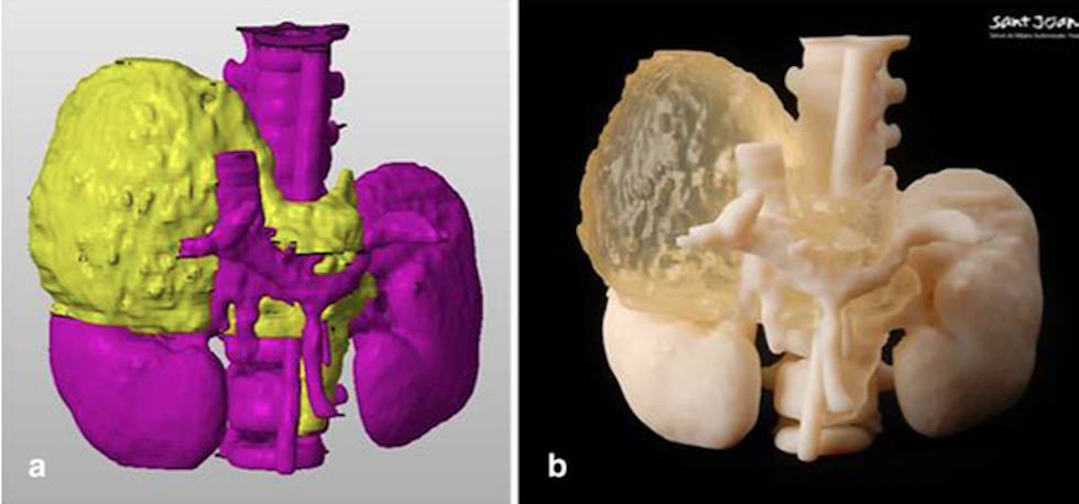 A la izquierda, reconstrucción digital del tumor. A la derecha, impresión en 3D con dos tipos de materiales.