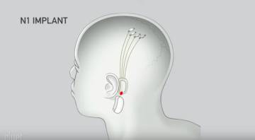 Elon Musk enseña su ambicioso plan para conectar el cerebro a internet