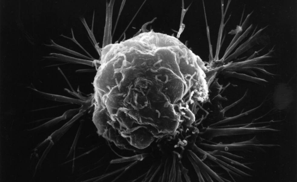 Célula de câncer de mama vista com microscópio eletrônico.