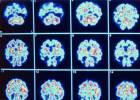 Identificado um novo tipo de demência confundido até agora com o Alzheimer