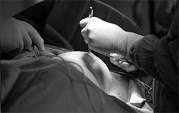 ¿Está sedado para una biopsia de próstata? ¿Está sedado para una biopsia de próstata?