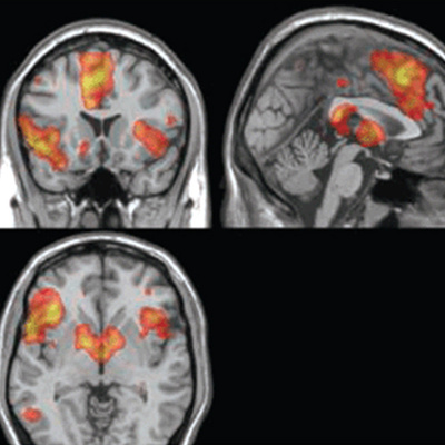 Que es resonancia magnetica cerebral