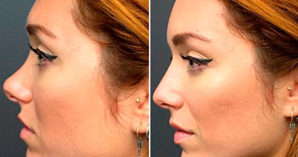 Así se 'opera' la nariz sin pasar por el quirófano