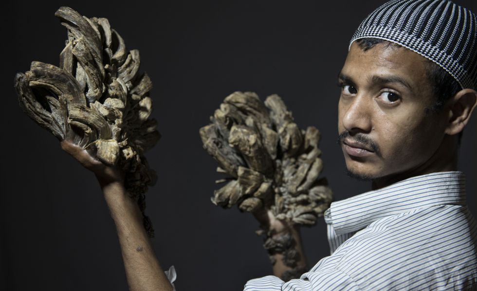 Abul Bajandar muestra sus manos afectadas. Mañana se someterá a una primera intervención en Dacca para eliminar sus verrugas. 