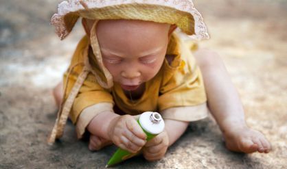 Niña albina en Tanzania.