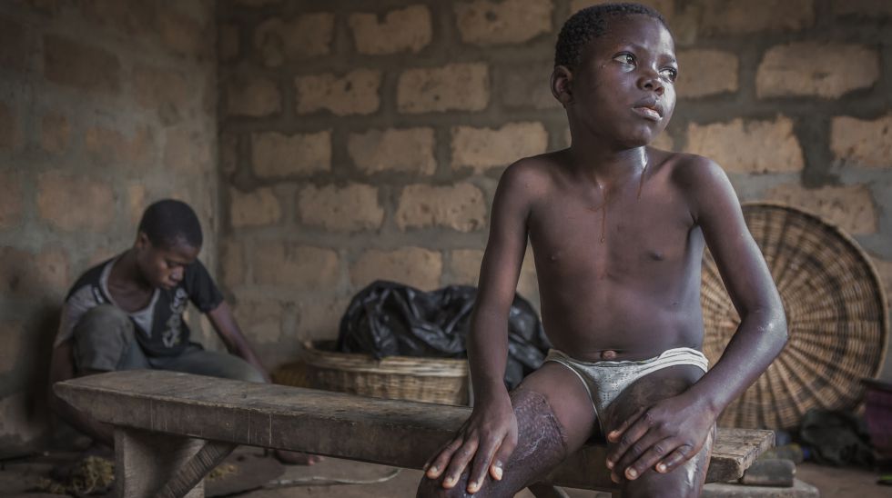 Aniwanou, ya recuperado después de tres intervenciones y varios meses de rehabilitación en su casa de Monzoungoudo, Benín.