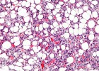 Un tejido con liposarcoma. Los c&iacute;rculos blancos son los ac&uacute;mulos de grasa.