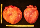 Corazón de un paciente fallecido por miocardiopatía dilatada (izquierda) y el de un sujeto sin esta enfermedad.