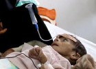 Udai Faisal, que sufre malnutrición severa, es alimentado por su madre en el hospital Al-Sabeen Hospital de Sanaa, en Yemen.