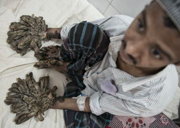 El apodado 'hombre &aacute;rbol', antes de su intervenci&oacute;n.