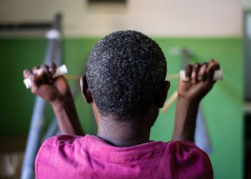 Ibrahim, diagnosticado con lepra, realiza ejercicios de rehabilitación en el hospital de Gambo, en Etiopía.