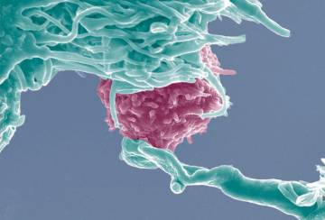 Las células T (en azul) serán modificadas para atacar las células del cáncer (en rosa) mediante CRISPR.