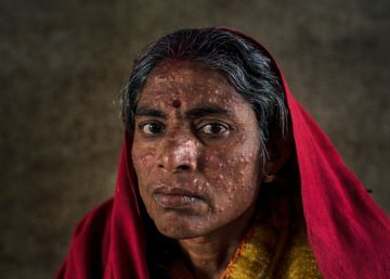 Una paciente de leishmaniasis en un hospital de MSF en Hajipur (India).